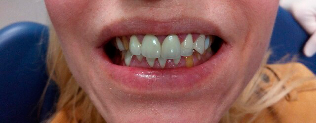 Clínica Dental Dr. Rafael Menéndez persona con carillas en los dientes